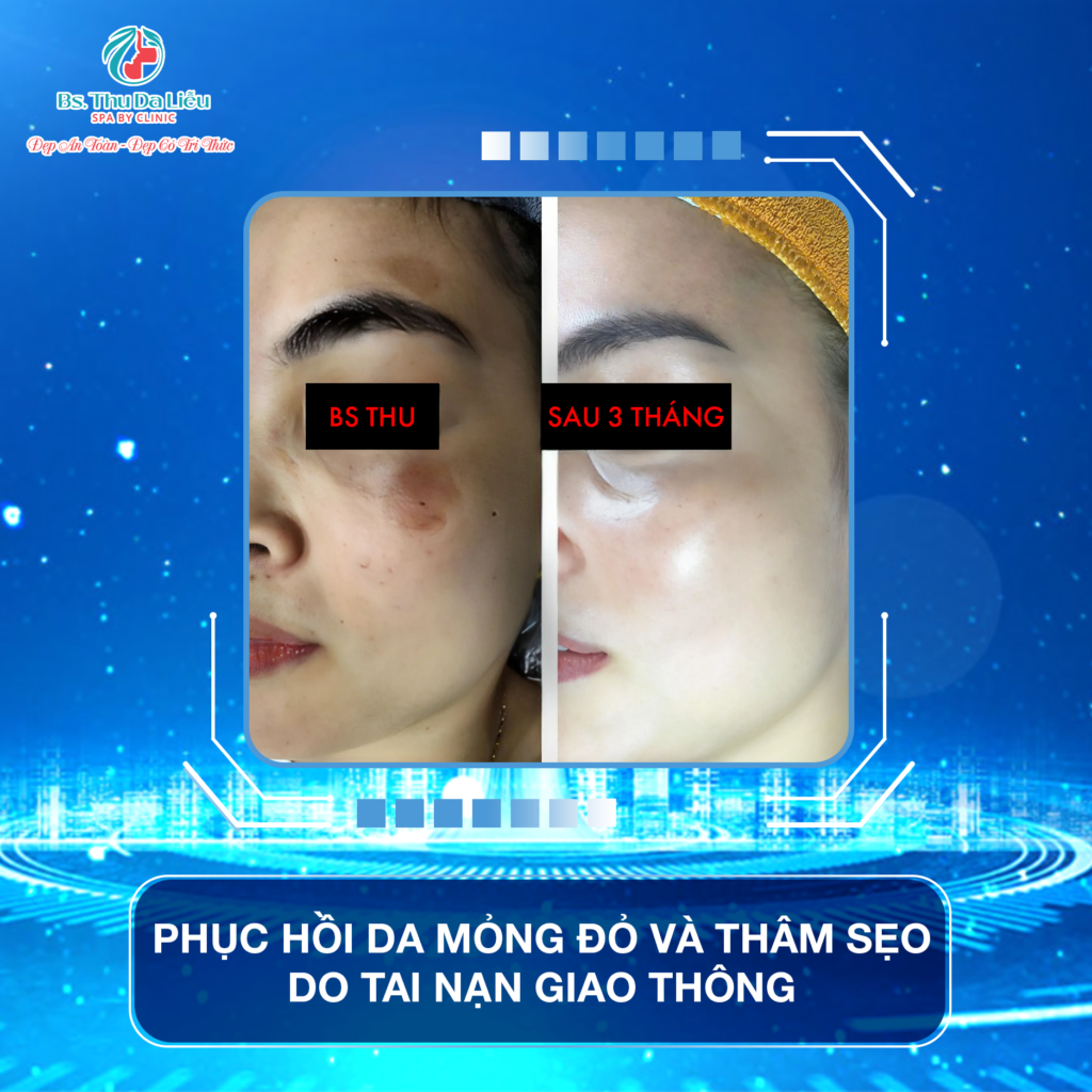 Điều trị sẹo rỗ