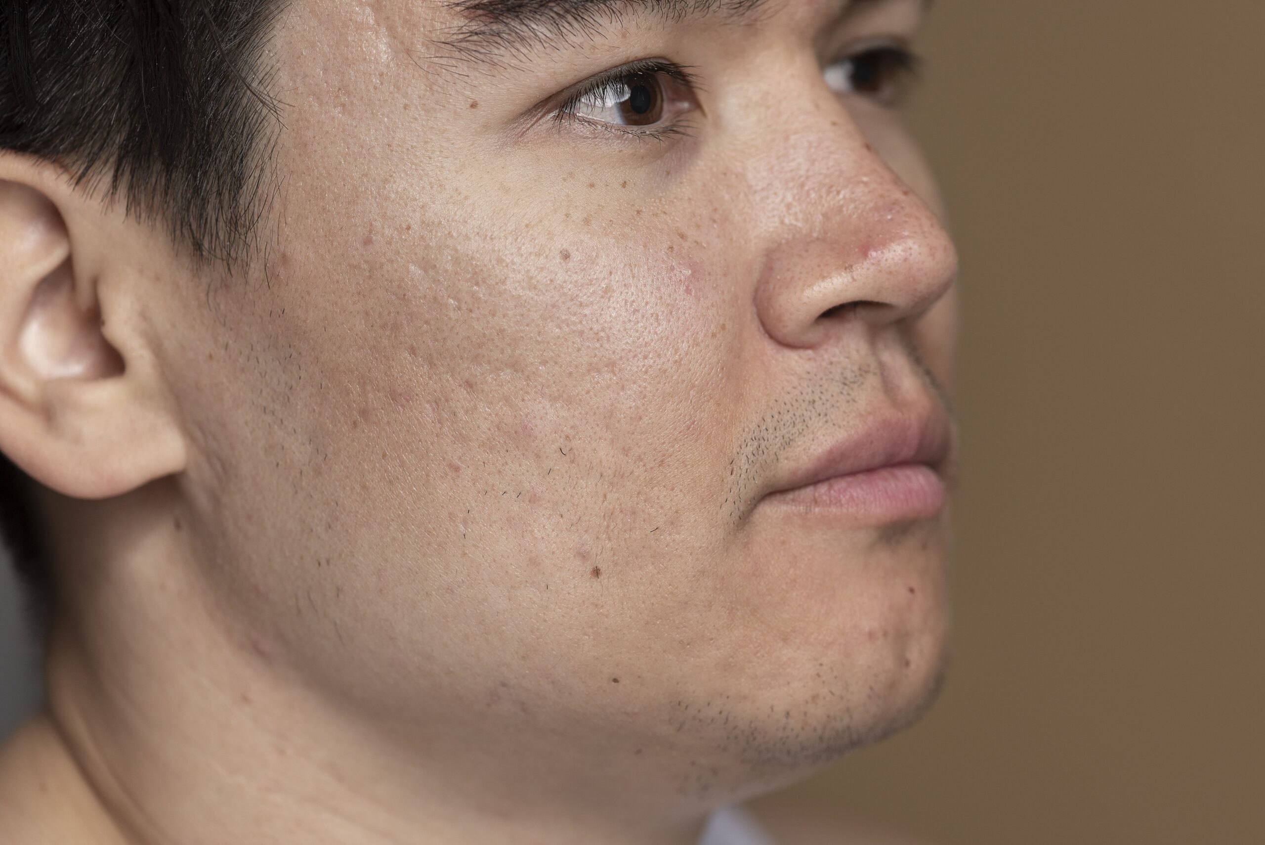 Chi phí điều trị Sẹo lõm