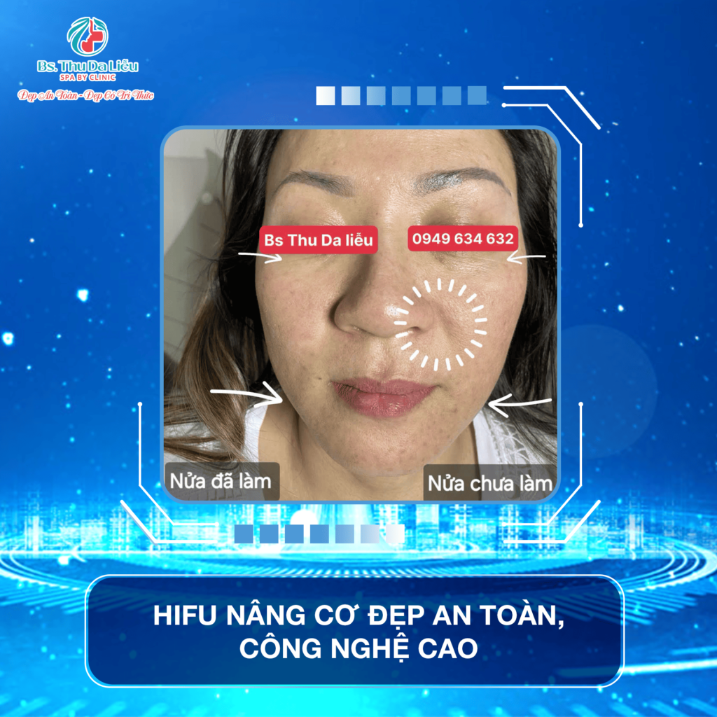 Công nghệ Hifu giá bao nhiêu?