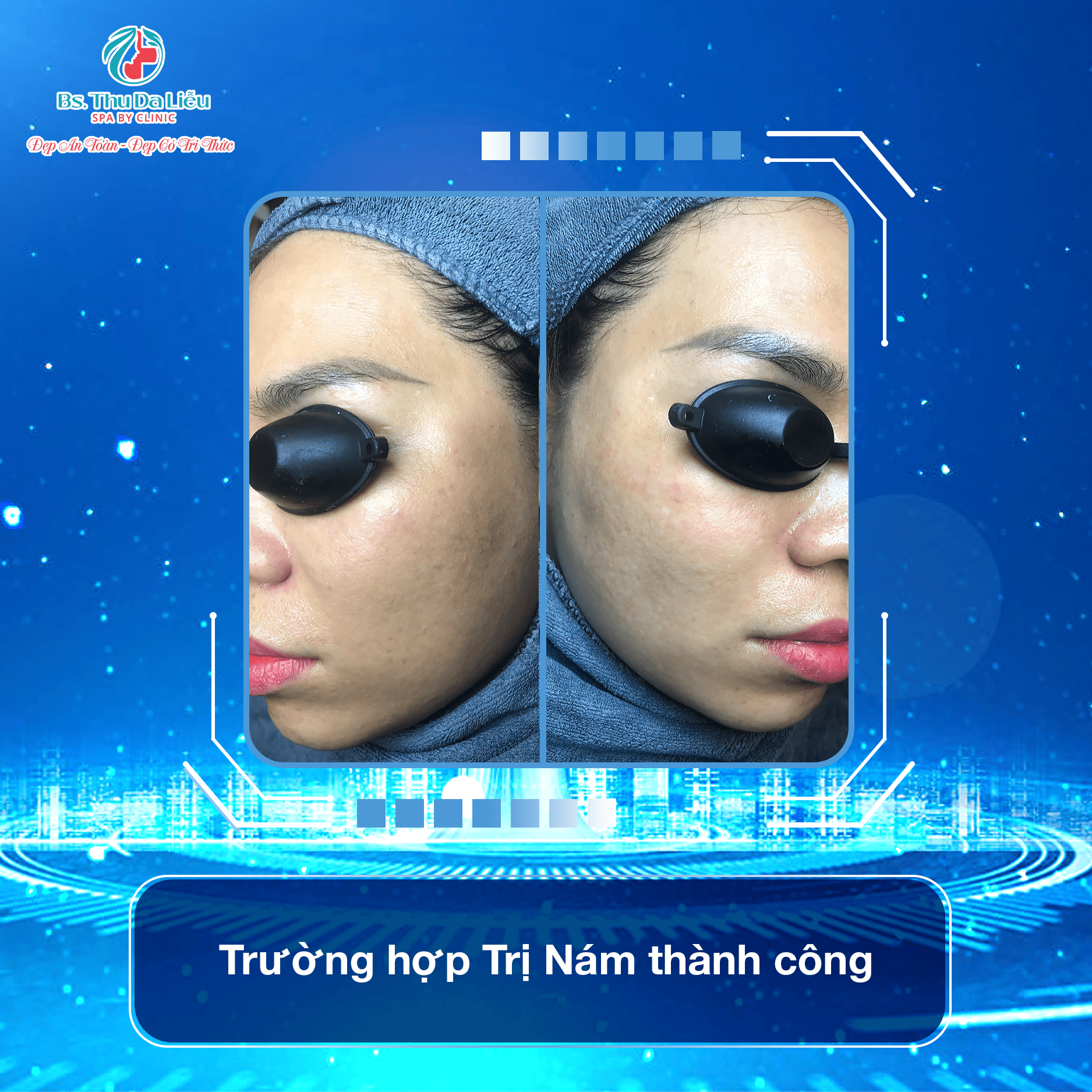 Điều trị Nám cần kiêng gì?