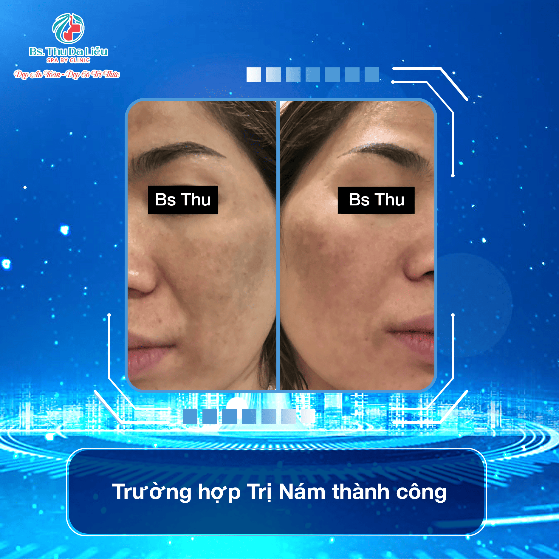Trị Nám bao nhiêu tiền