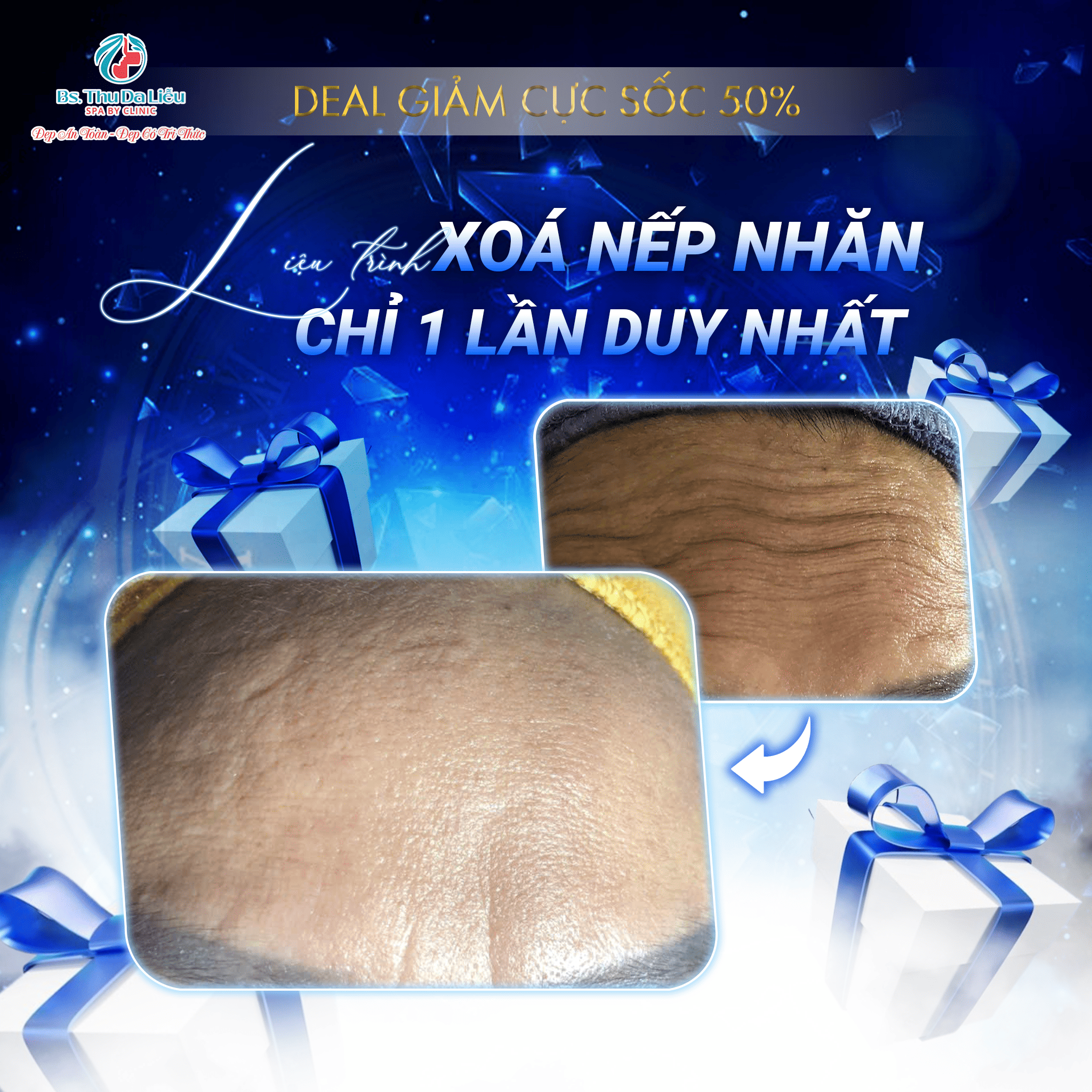 Tiêm xóa nhăn mắt có ảnh hưởng gì không?