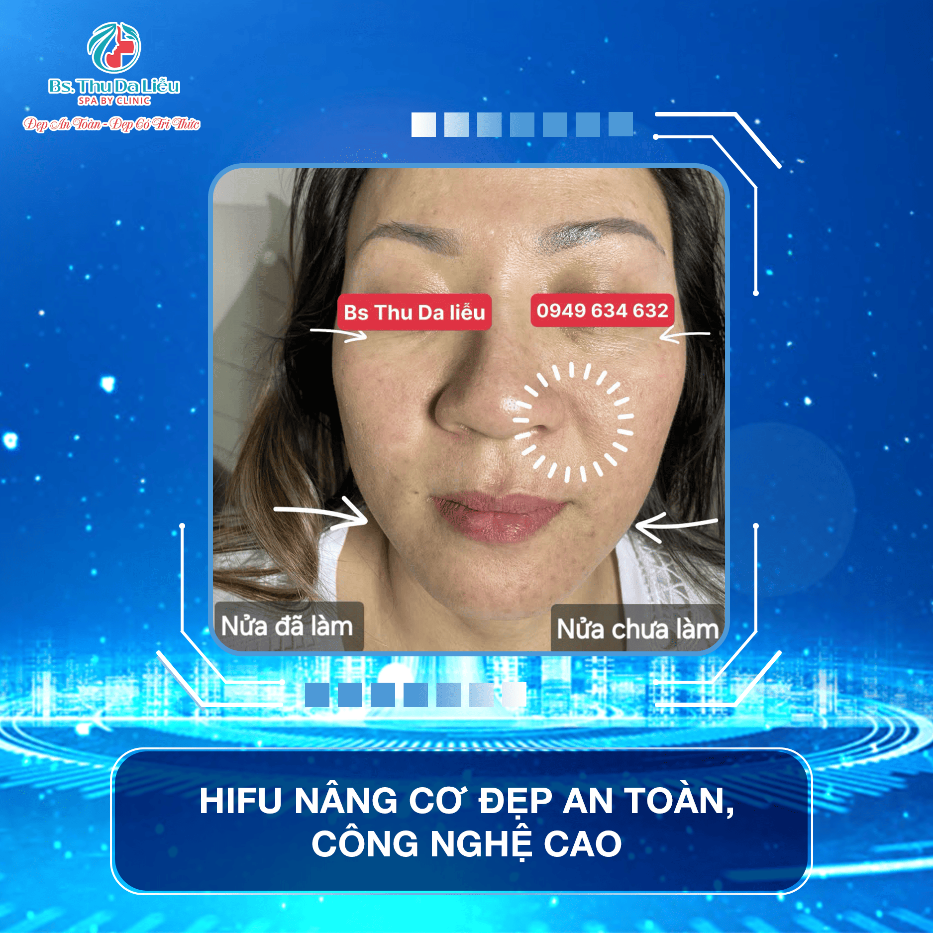 Nâng cơ Hifu giá bao nhiêu?