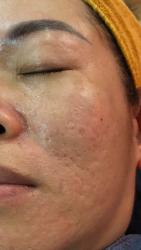 Trị sẹo rỗ uy tín TP.HCM