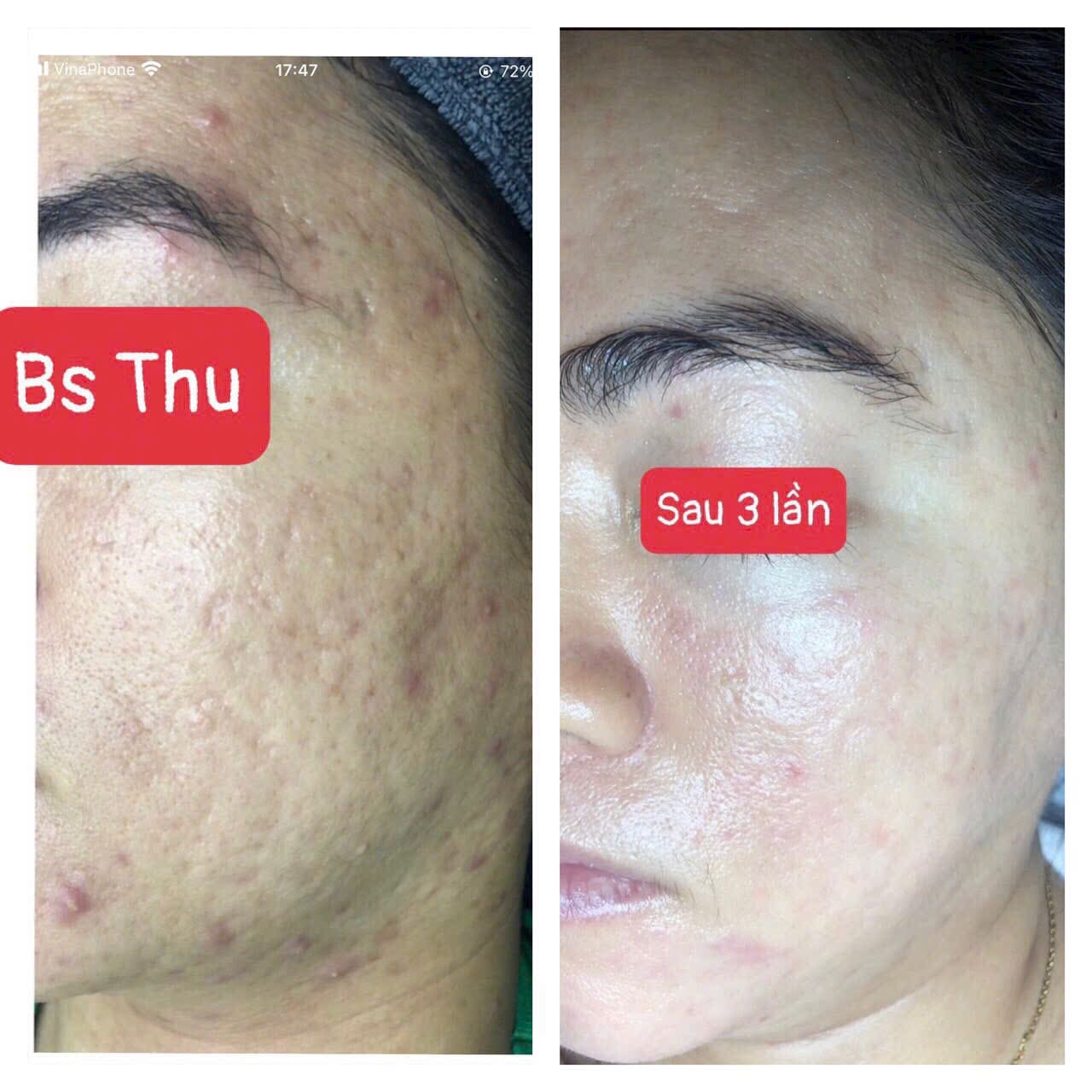 Trị mụn Quận 12 chuẩn y khoa