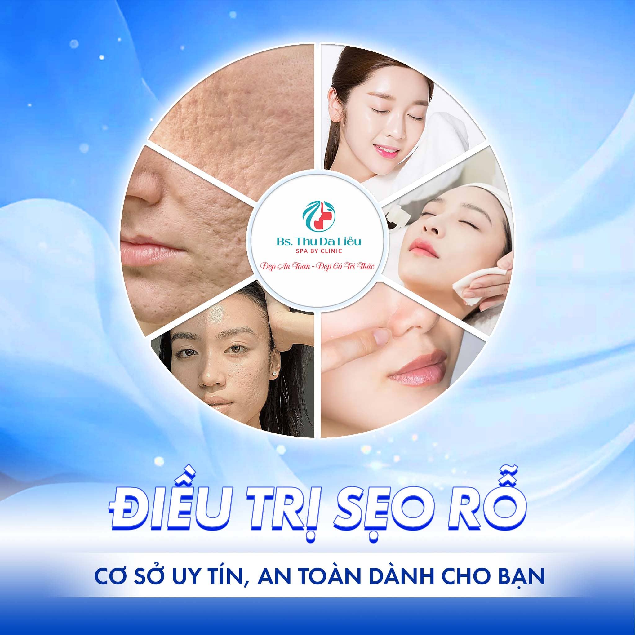 Các phương pháp điều trị Sẹo rỗ