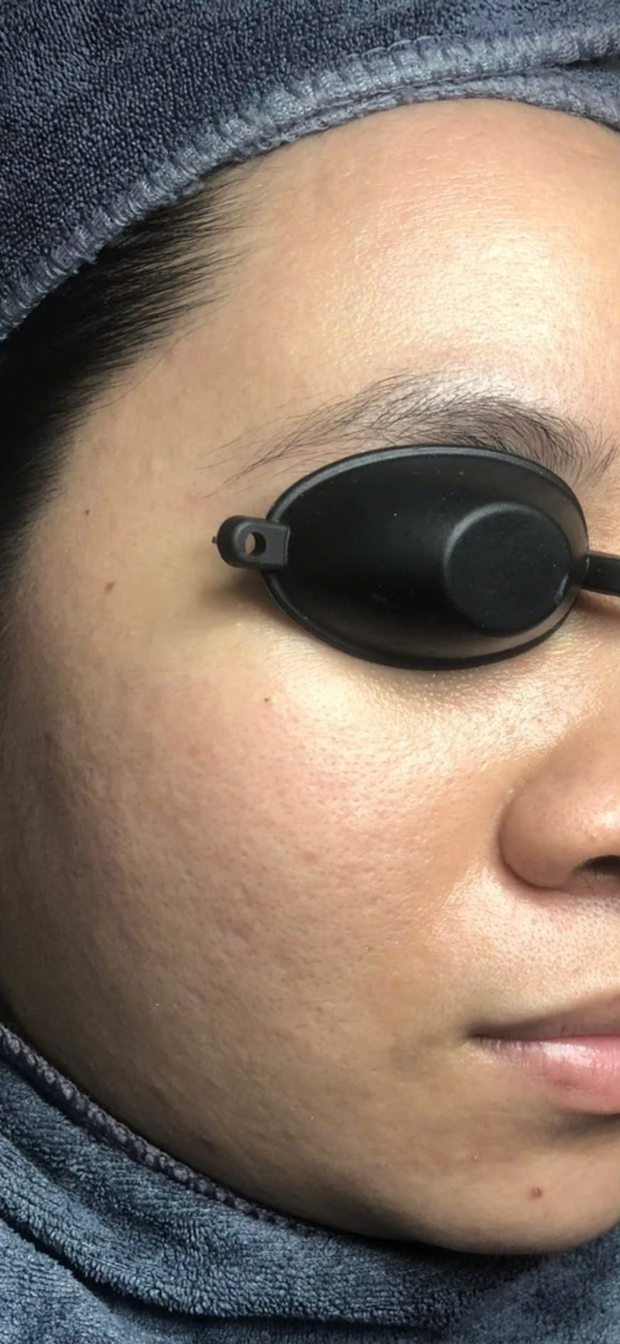 Trị sẹo rỗ uy tín TP. HCM ở đâu?