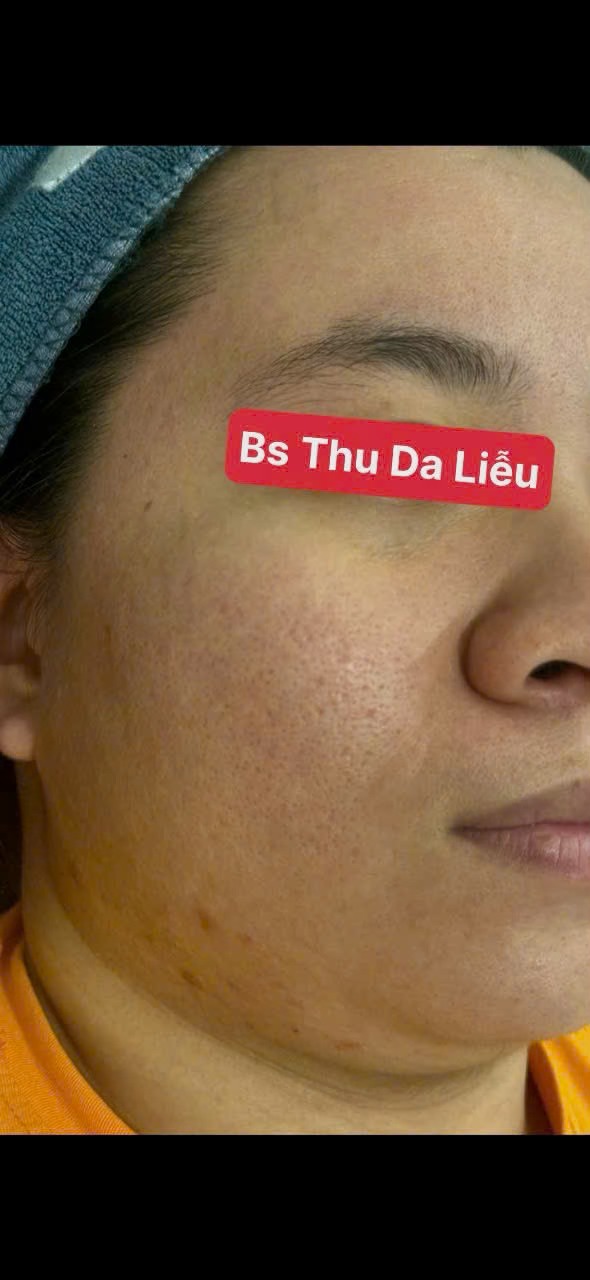 Trị sẹo rỗ uy tín TP. HCM ở đâu?
