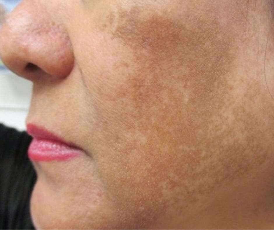 Spa trị nám ở TP.HCM: Sora Clinic lựa chọn hàng đầu