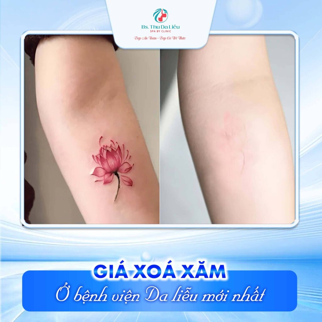 Giá xoá xăm ở bệnh viện Da liễu