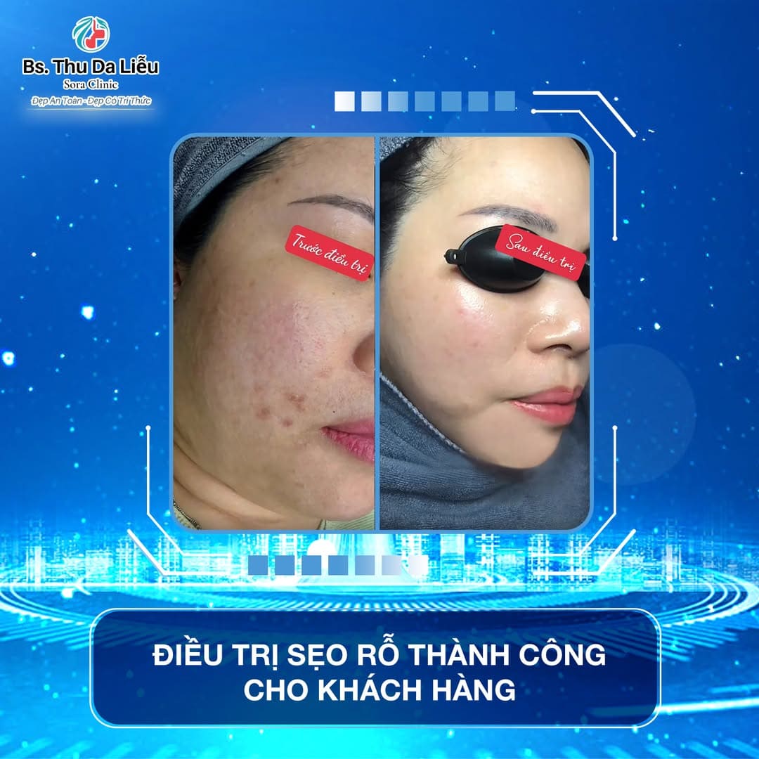Trị sẹo rỗ uy tín TP.HCM tại Sora Clinic spa