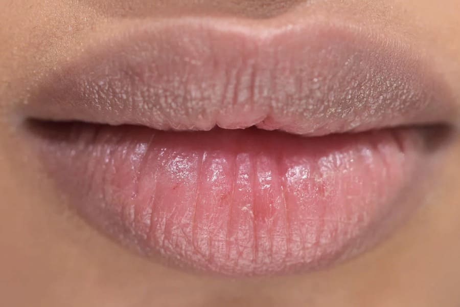 Khử Thâm môi bao nhiêu tiền?