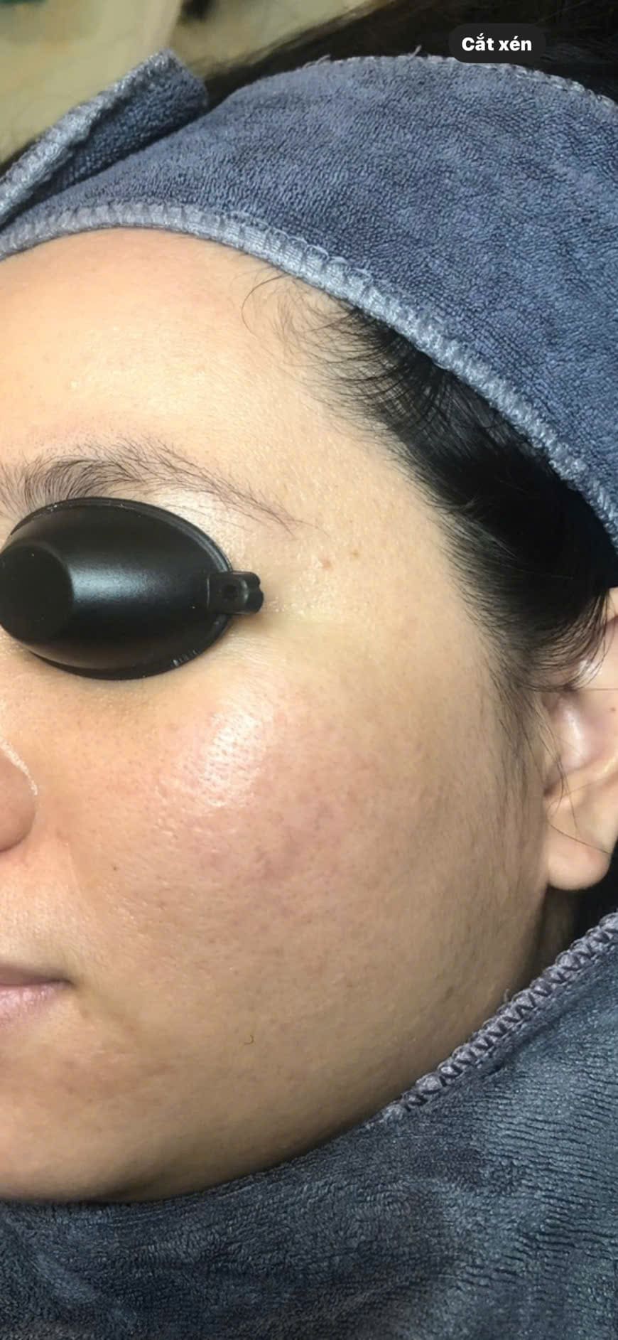 Trị Sẹo rỗ ở đâu tốt nhất TP.HCM