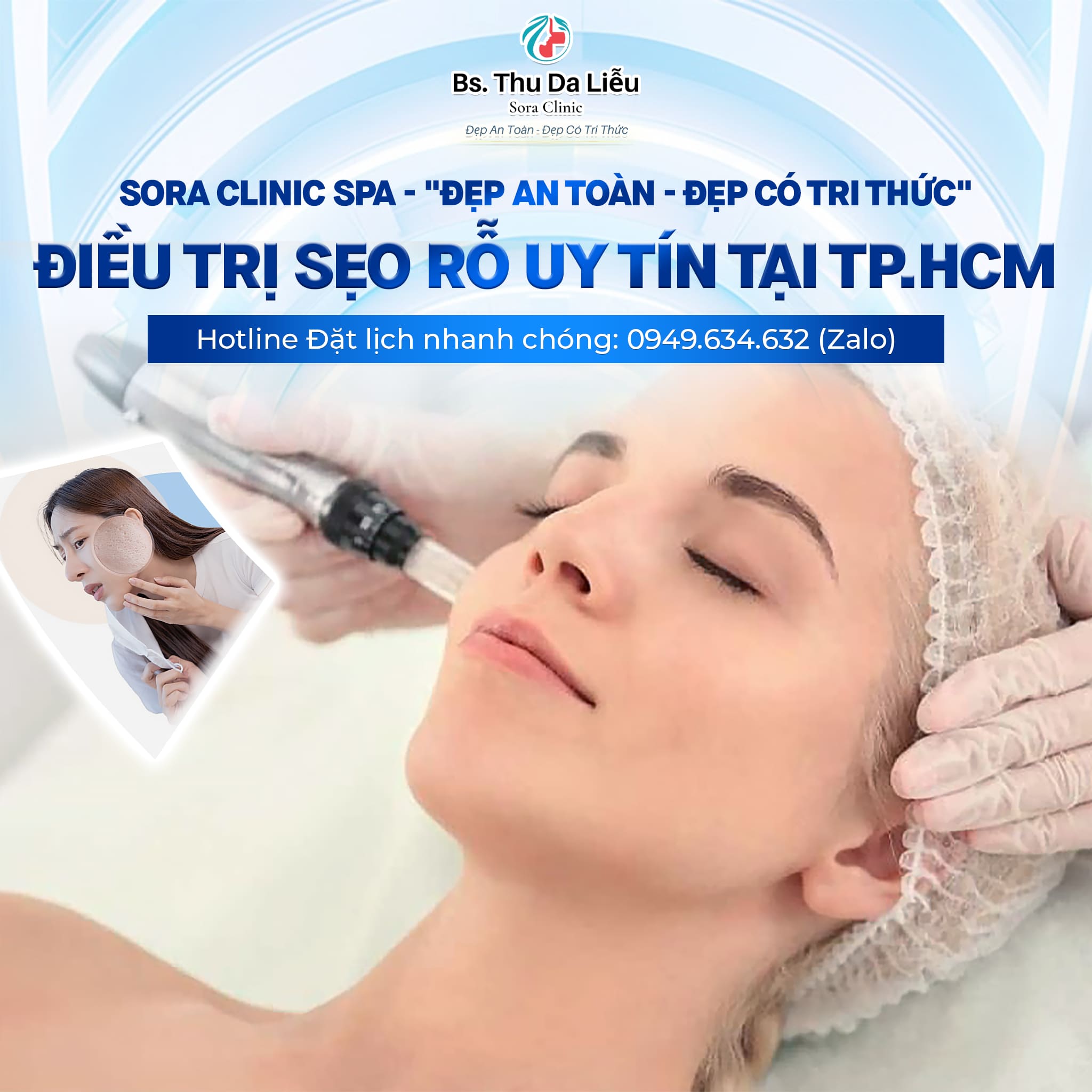Các phương pháp điều trị Sẹo rỗ