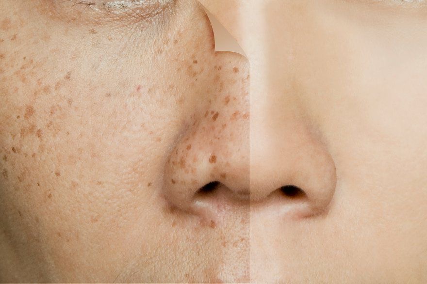 Khám Da liễu quận 12