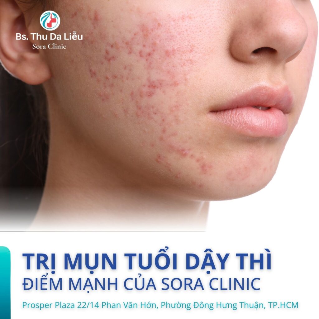Trị mụn dậy thì hiệu quả tại Sora