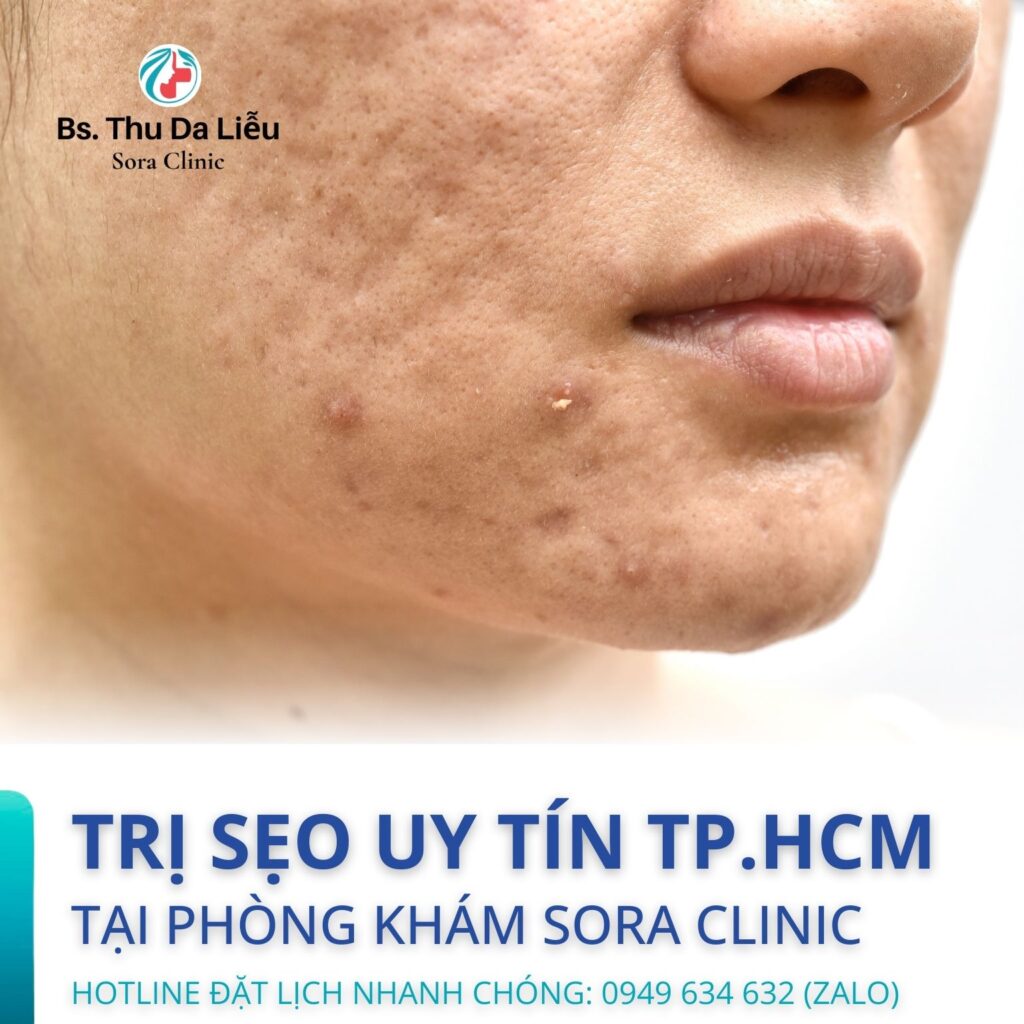 sẹo rỗ do mụn lâu năm cần điều trị sớm để đạt hiệu quả