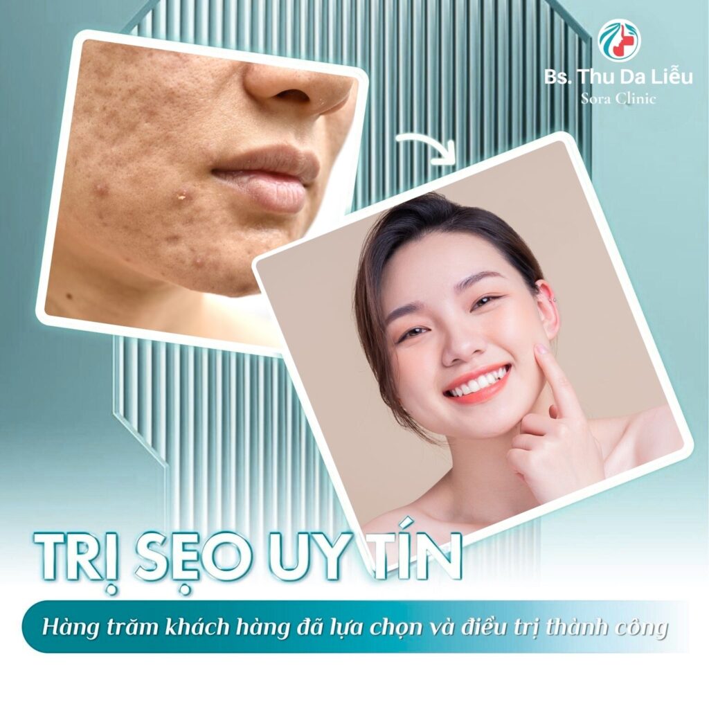 hiệu quả điều trị sẹo rỗ tại Sora Clinic