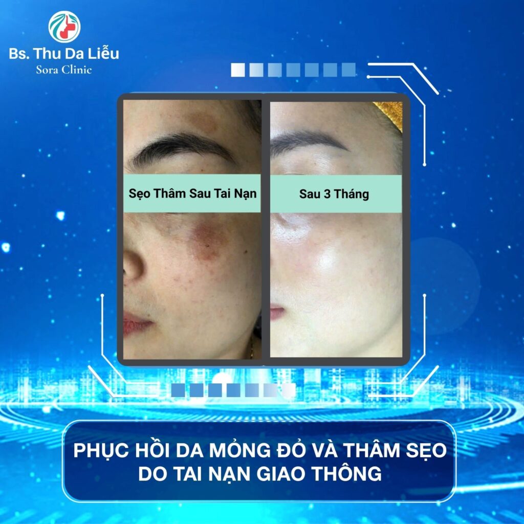 Trị sẹo thâm do tăng sắc tố hiệu quả an toàn