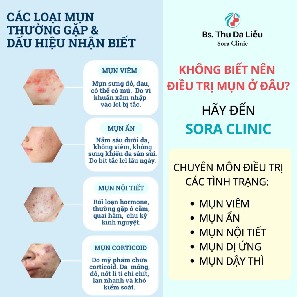 các loại mụn thường gặp trên da mặt