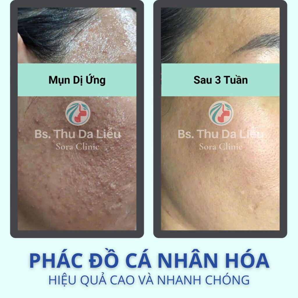 trị mụn Quận 12 tại Sora Clinic