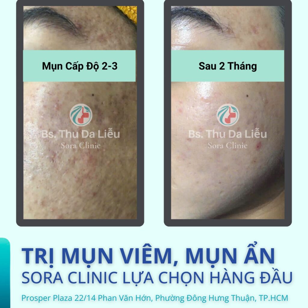 Khách điều trị thành công mụn cấp độ nặng sau 2 tháng tại Sora Clinic