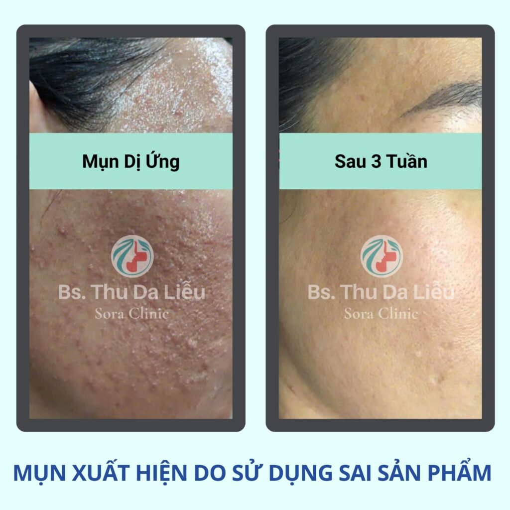Mụn viêm xuất hiện do sử dụng sai sản phẩm skincare
