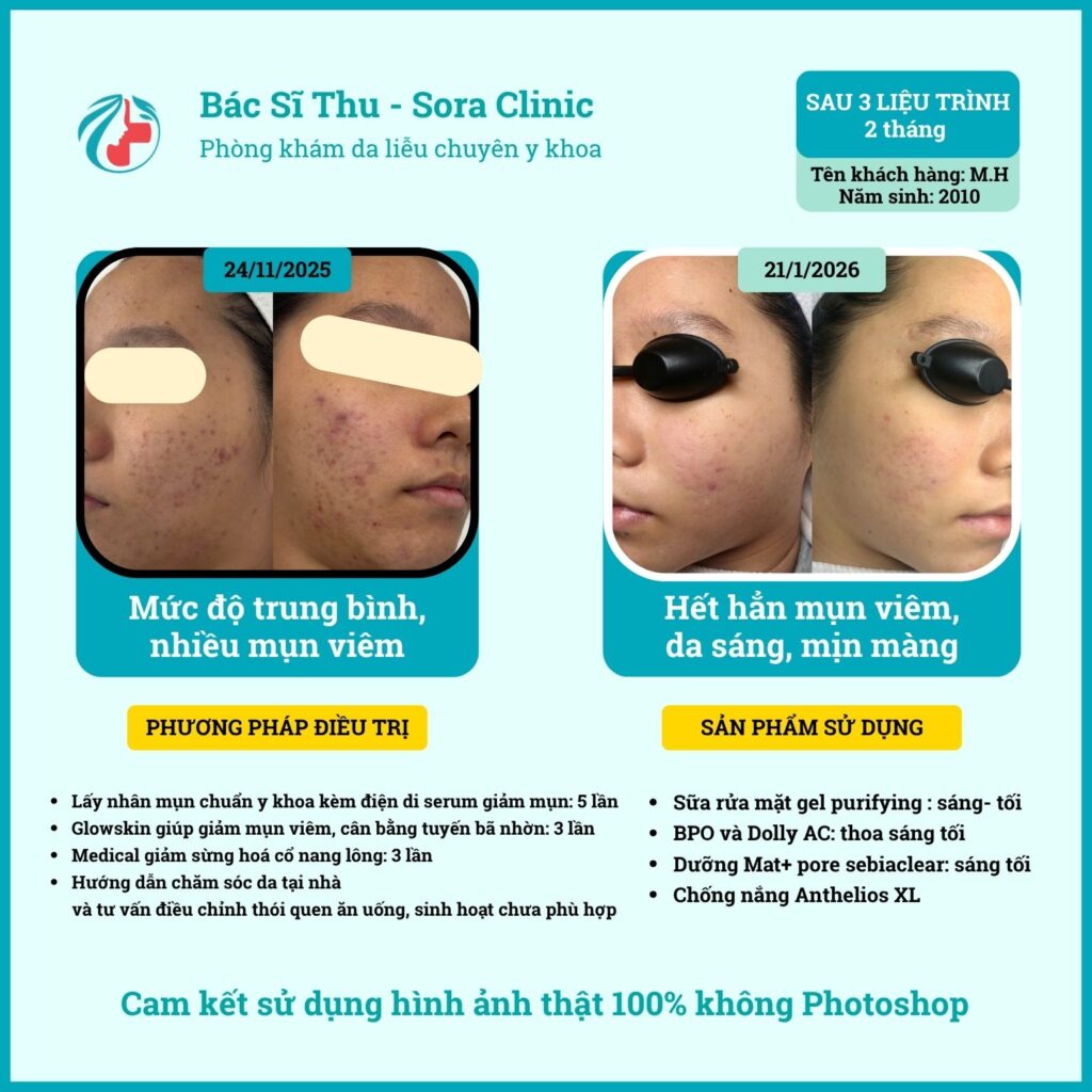 Da ổn định hơn khi điều trị mụn đúng cách tại phòng khám Sora Clinic quận 12