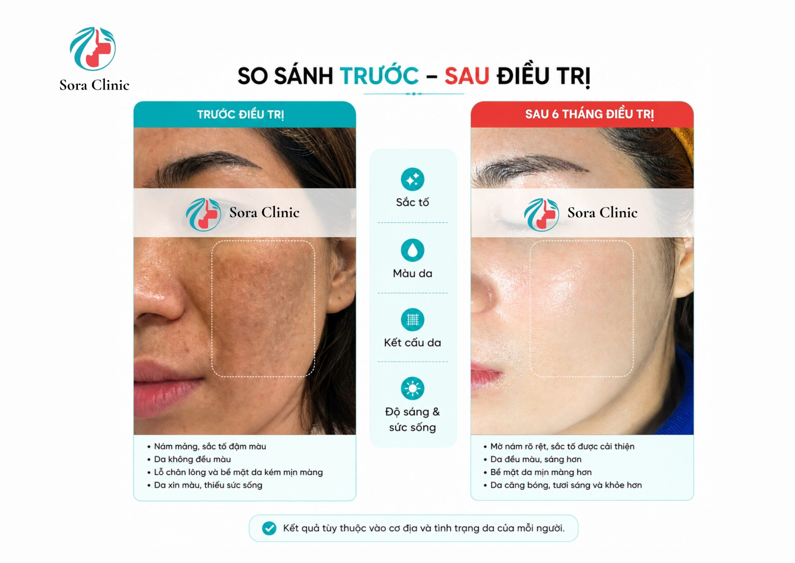 Kết quả khách hàng trị nám tại Bs Thu da liễu quận 12 - Sora Clinic